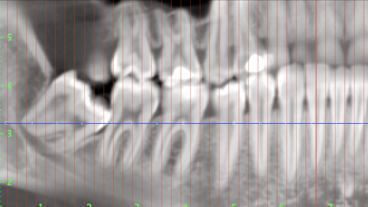 O radiografie panoramică a maxilarelor, folosită la planificare.