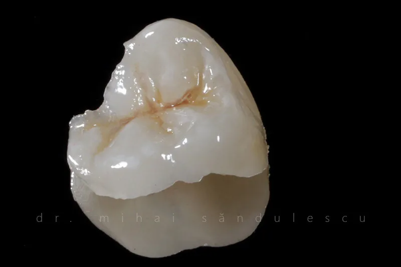O coroană ceramică pentru un molar, pe fundal negru.