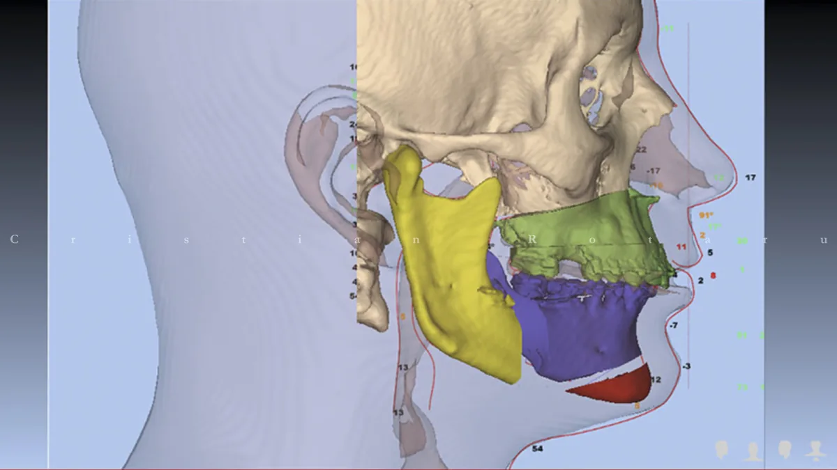 Planul 3D al unei chirurgii ortognate: craniul reconstruit din tomografie, cu maxilarul și mandibula colorate în poziția planificată.